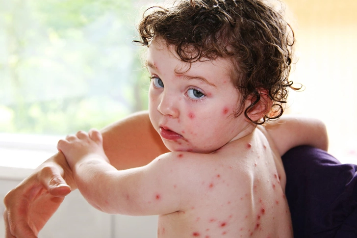 Chickenpox and Shingles Chickenpox and Shingles
