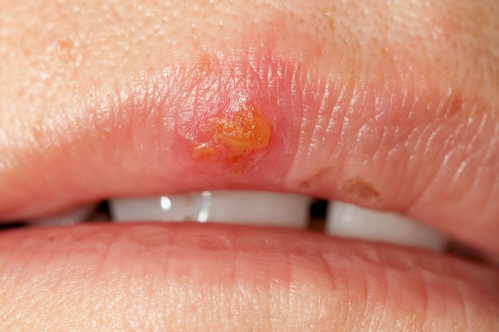 Cold Sores Cold Sores