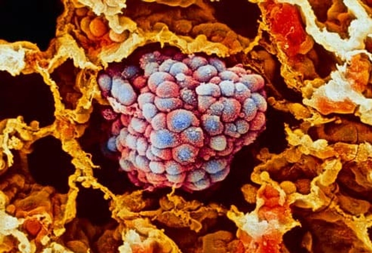 COPD and Cancer