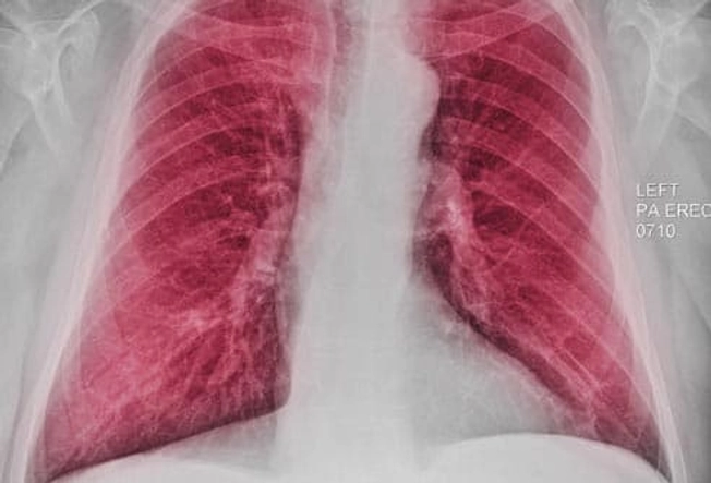 Diagnosis: Chest X-Ray