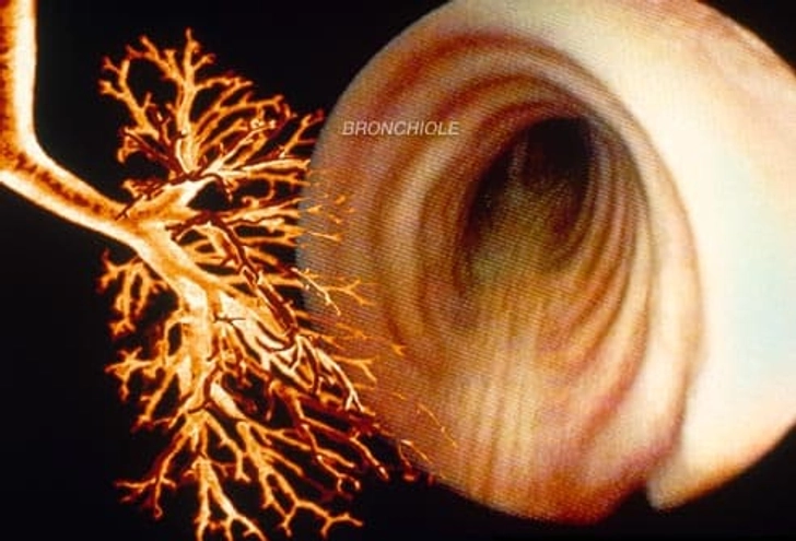 COPD: Chronic Bronchitis