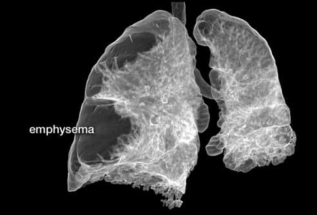 COPD: Emphysema