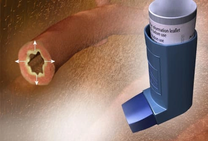 Treatment: Bronchodilators