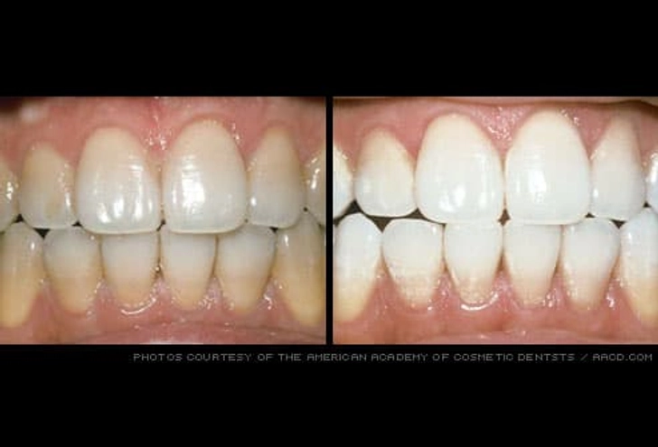 Teeth Whitening