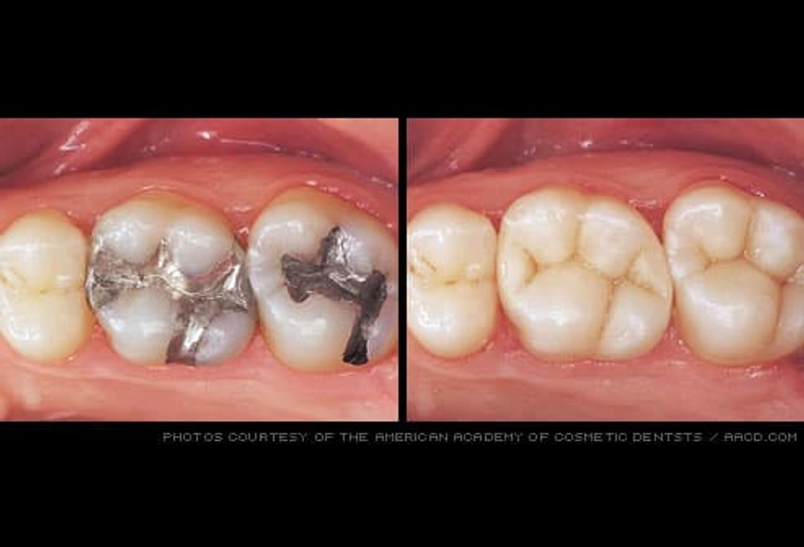 Composite Fillings