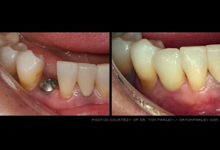 Implants