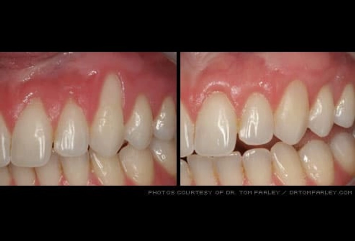 Gum Grafts