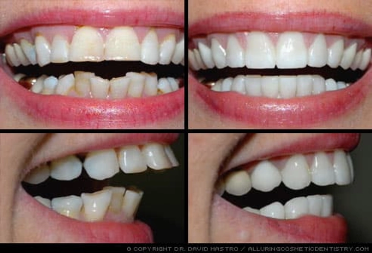 Smile Makeovers
