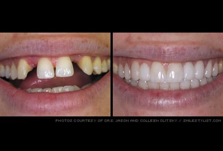 Bridges (fixed partial dentures)
