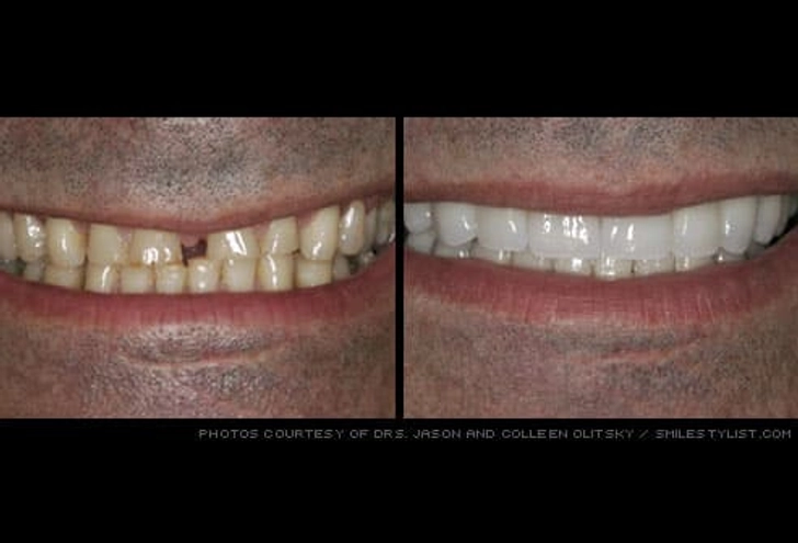 Veneers
