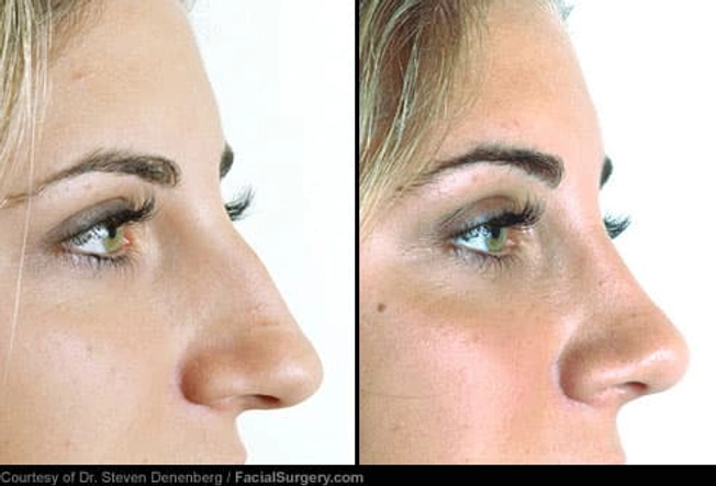 Nose Job: Before and After