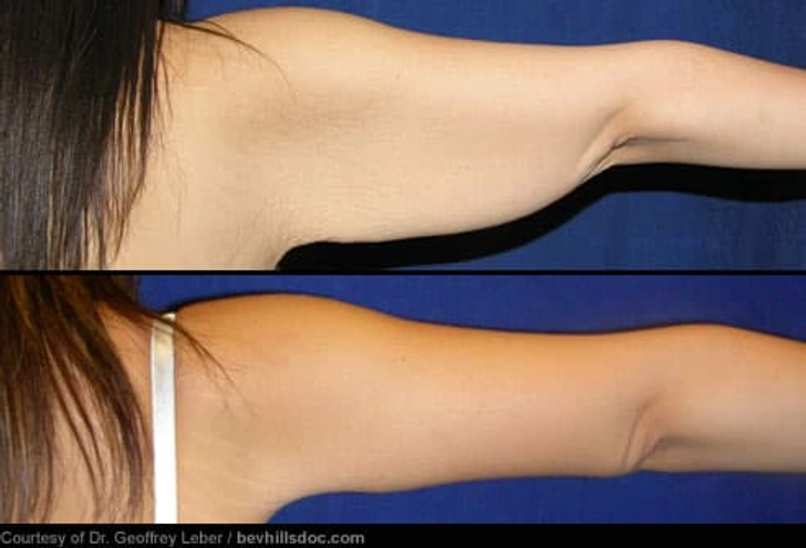 Arm Lift: Before and After Arm Lift: Before and After