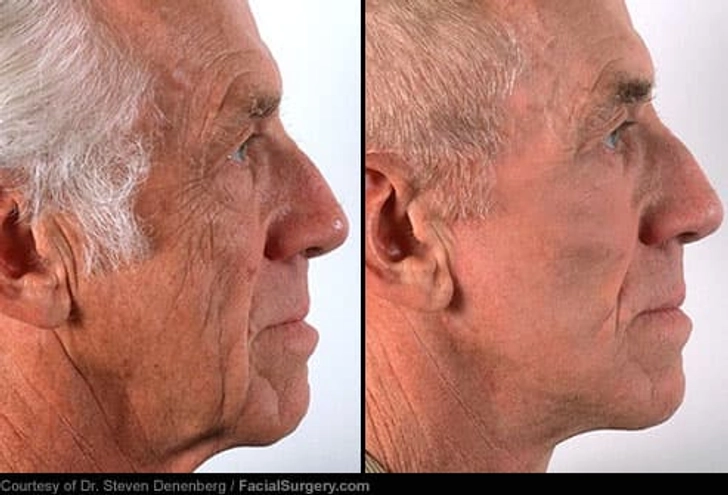 Facelift: Before and After