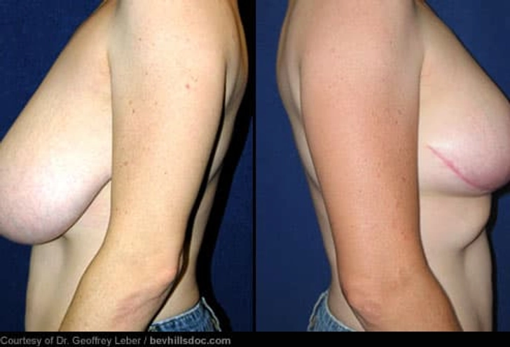 Breast Reduction: Before and After Breast Reduction: Before and After