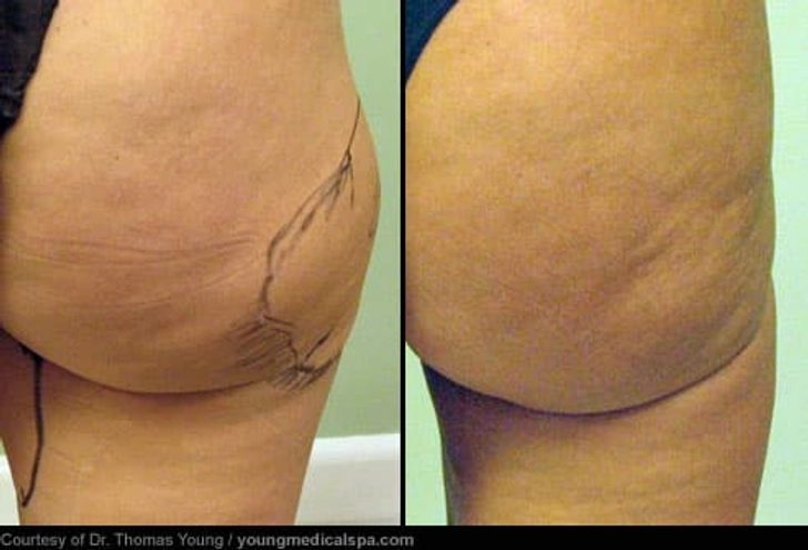 Liposuction: Before and After Liposuction: Before and After