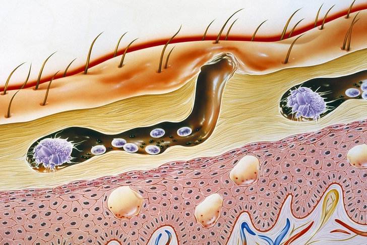 Scabies Scabies
