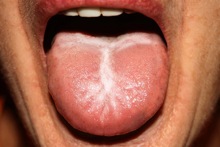 Candida: The Fungus Among Us