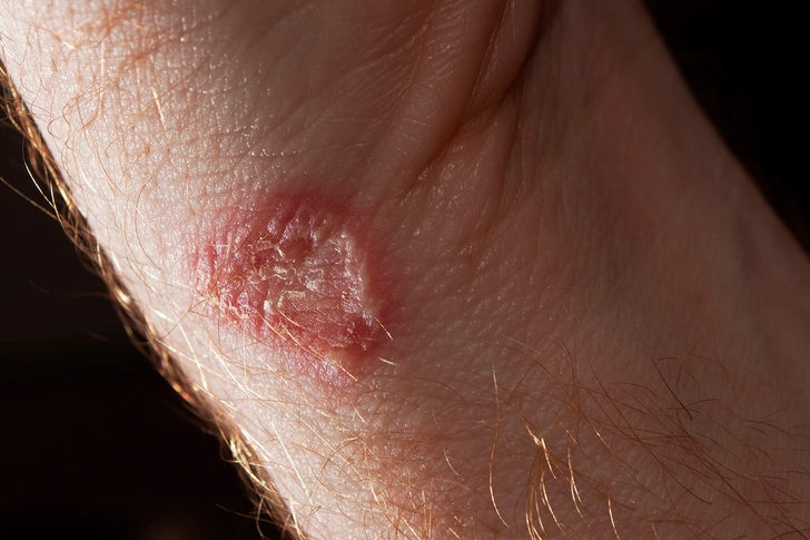 Ringworm