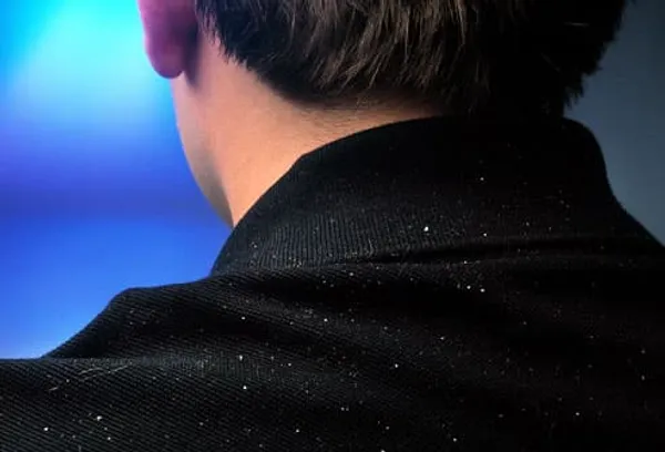 dandruff on mans shoulder