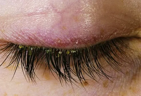 eyelid with dermatitis