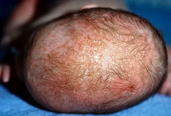 baby with dermatitis
