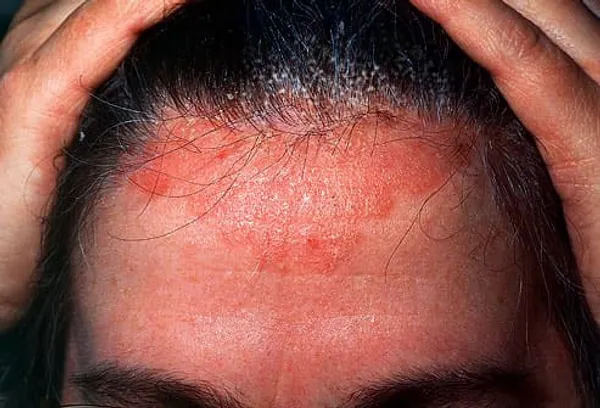 forehead with dermatitis