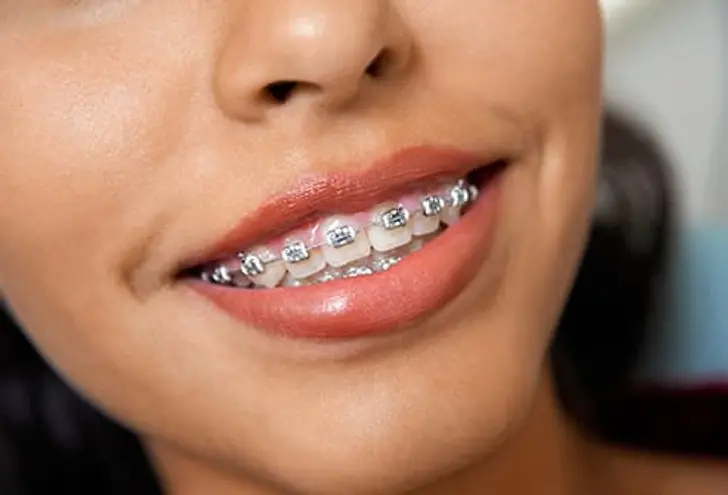 Braces