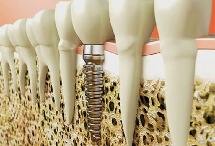 Implants
