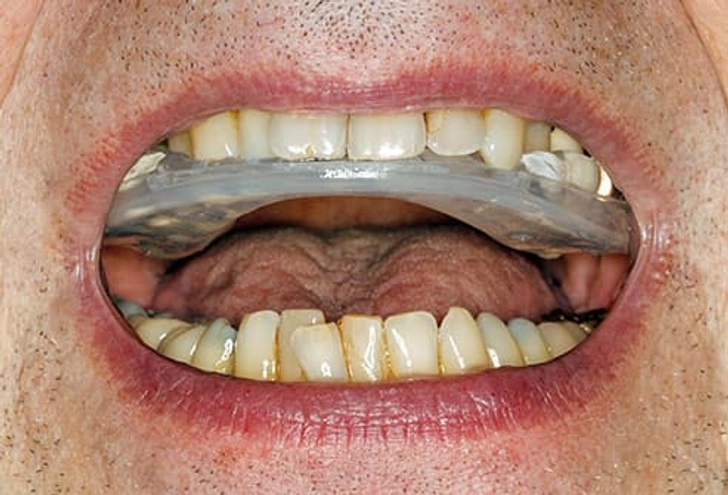 Occlusal Guards
