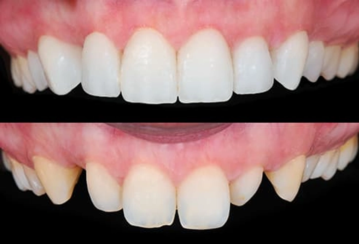 Veneers