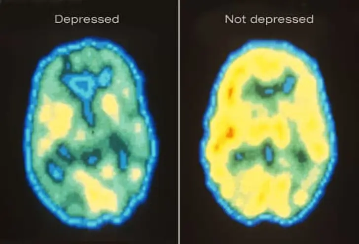 Depression: What Is It?
