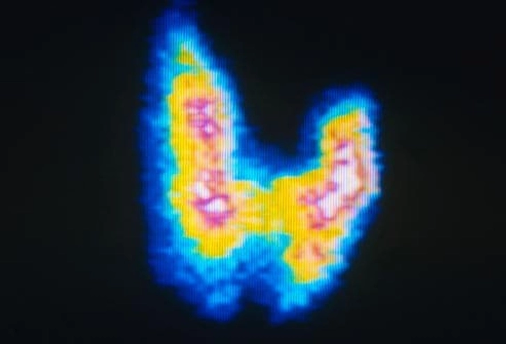 Trigger: Thyroid Disorders