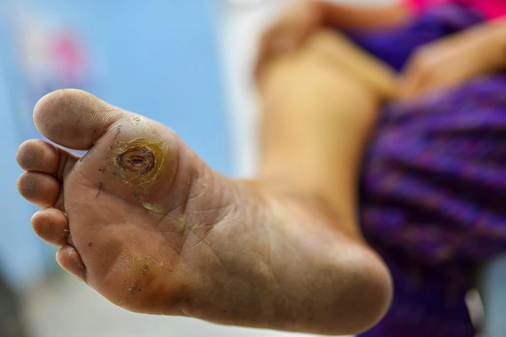 Foot Ulcers
