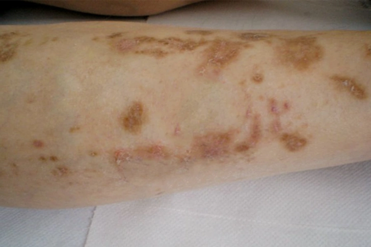 Shin Spots (Diabetic Dermopathy)