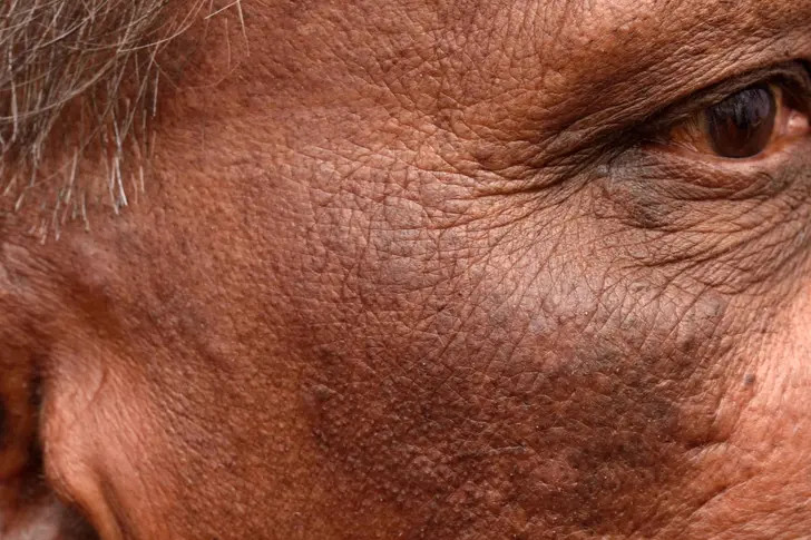 Acanthosis Nigricans Acanthosis Nigricans