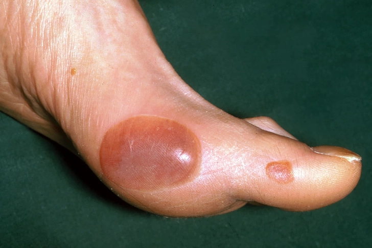 Diabetic Blisters Diabetic Blisters