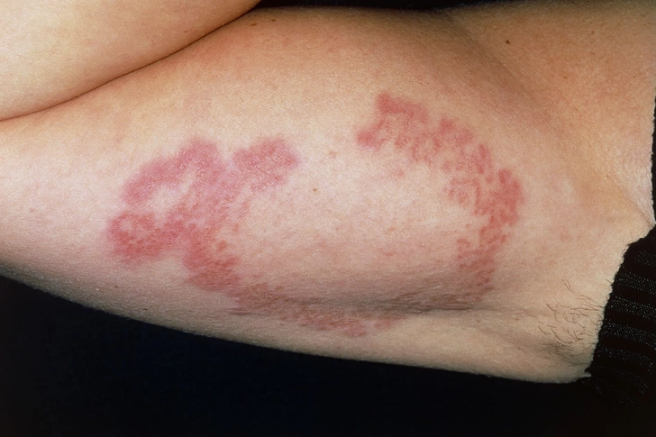 Granuloma Annulare Granuloma Annulare