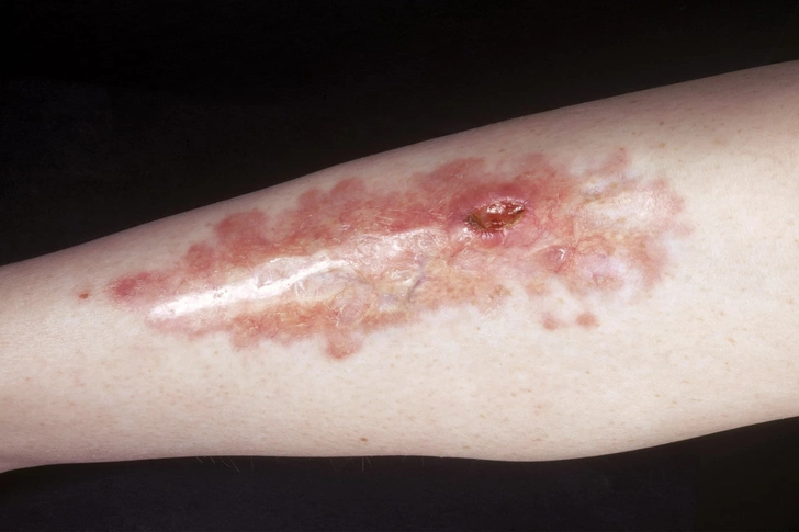 Necrobiosis Lipoidica Necrobiosis Lipoidica