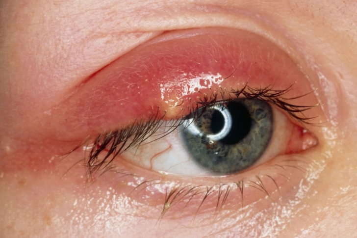 Bacterial Infection