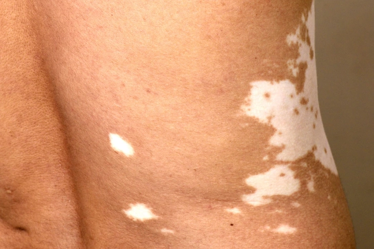 Vitiligo