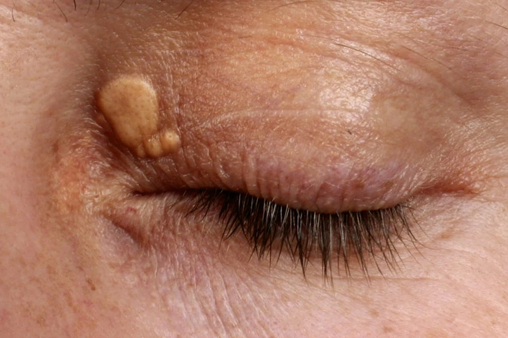 Xanthelasma Xanthelasma