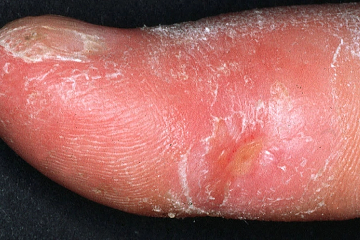 Thickened Skin Thickened Skin