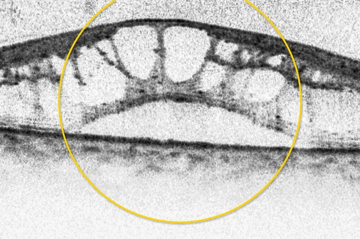 Diabetic Macular Edema