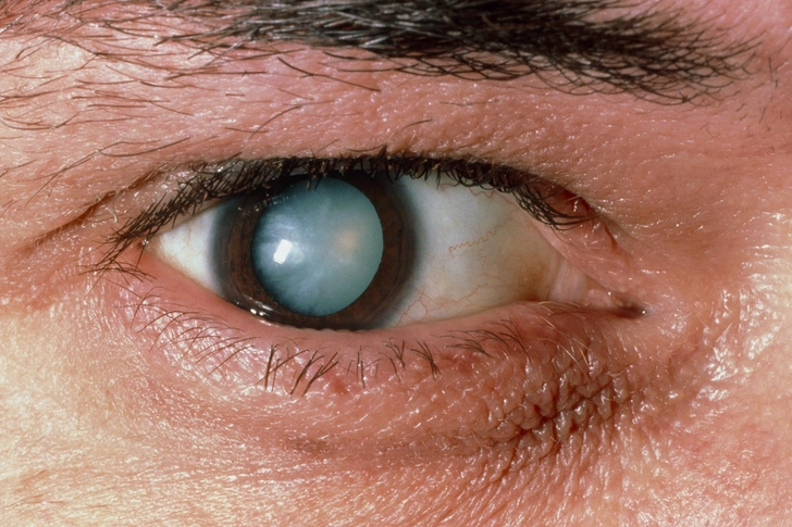 Cataracts