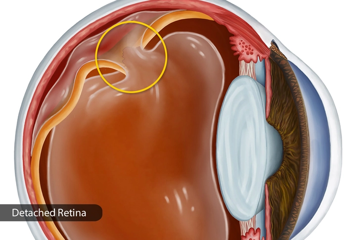 Advanced Diabetic Retinopathy