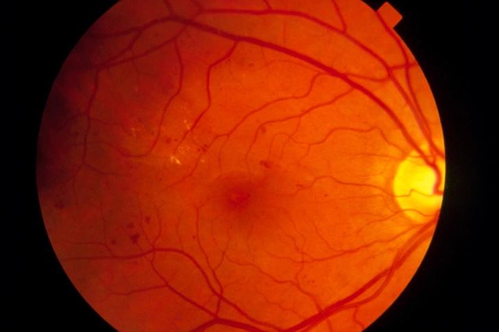 Early Diabetic Retinopathy