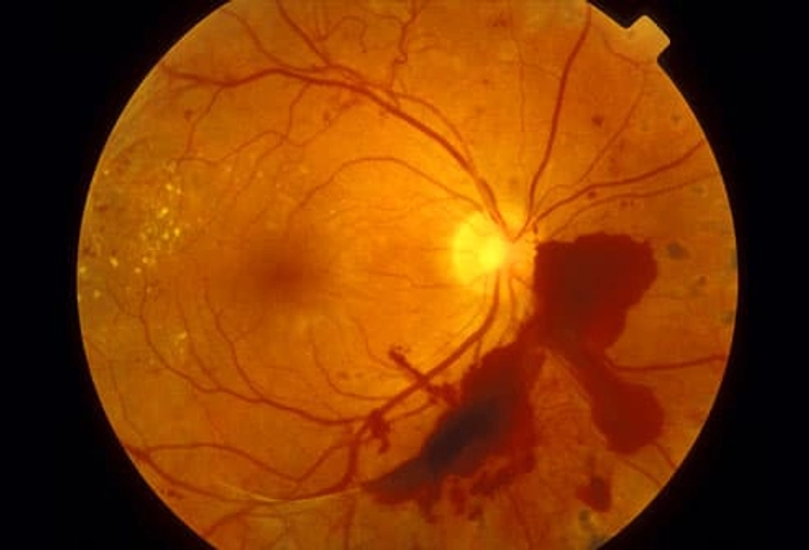 Eye Problems
