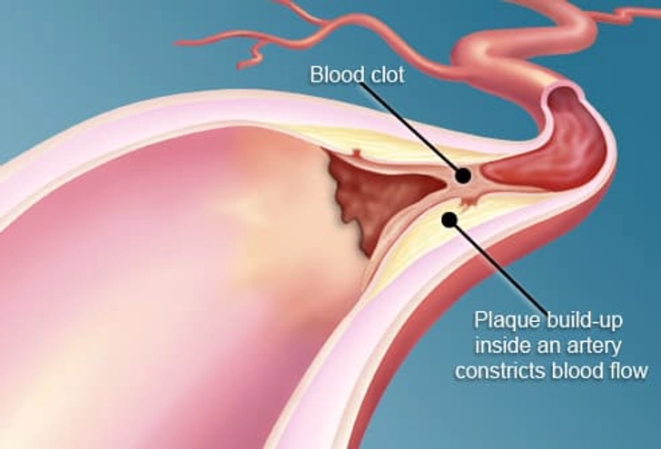 Heart and Artery Troubles