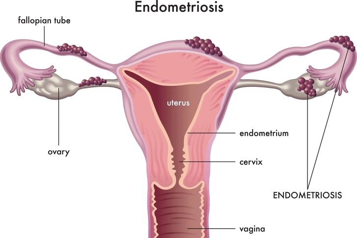 GI-Involving Endometriosis