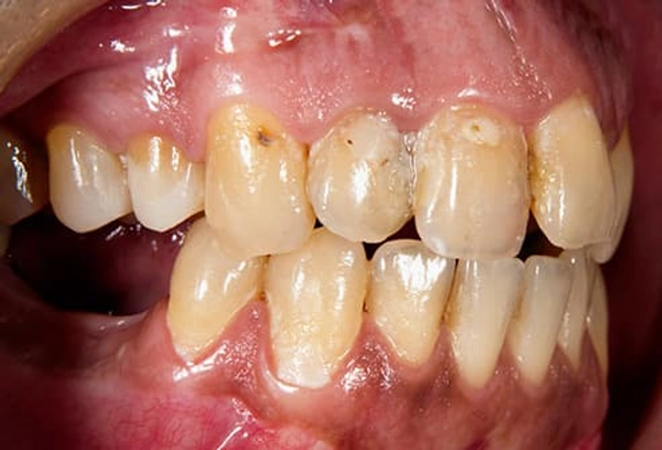 Gum Disease
